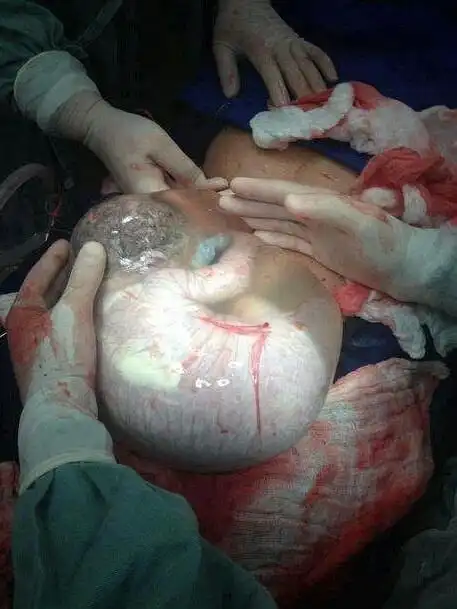 羊膜囊完好无损的剖腹产新生儿婴儿仍然从胎盘呼吸他甚至不知道外面的