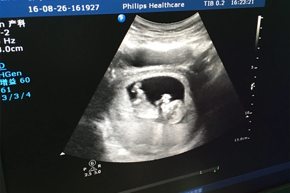 喧闹!三个月男女胎儿区别图"百花争艳"-第1张图片-追风博客