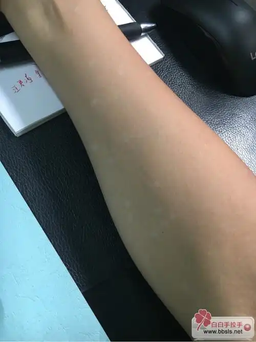 大家过来看一看瞧一瞧,这种点状白斑好治疗吗?