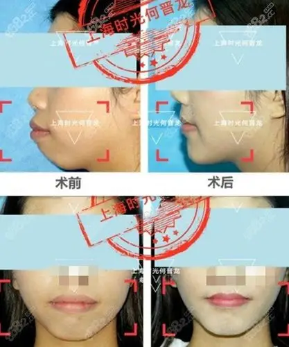 上海时光何晋龙正颌手术前后对比图