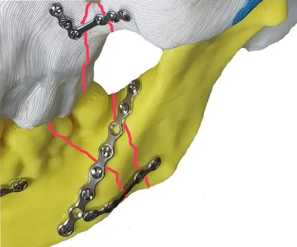 接骨螺钉规格-钛板钛钉价格-颅骨修补钛网供应-上海伍健医疗器械有限