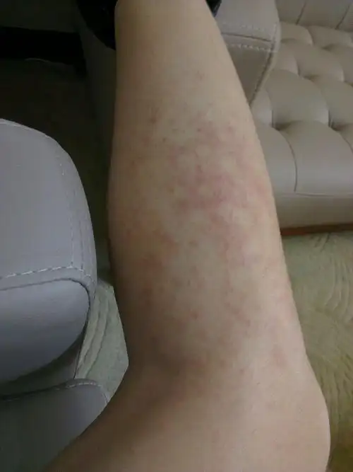 急求高手解答,腿上长了一颗颗的,最后长成一个圈形,受热会痒,医生有说