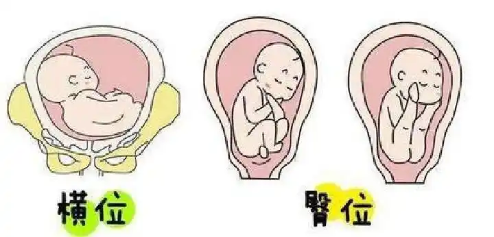 胎儿在体内横位和臀位的区别图片展示