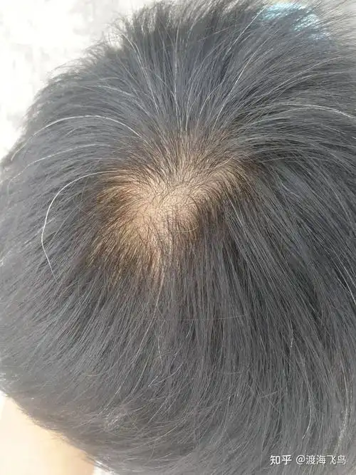 非那雄胺生发使用记录