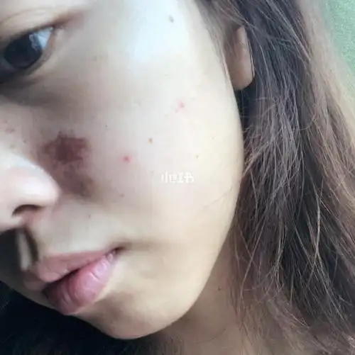 果酸灼伤 烂脸恢复记 ________10月更新________ 大家都关心是否恢复