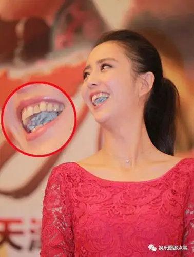 佟丽娅出席活动捞金,开口大笑满口黄牙辣眼睛口中白色异物引争议!