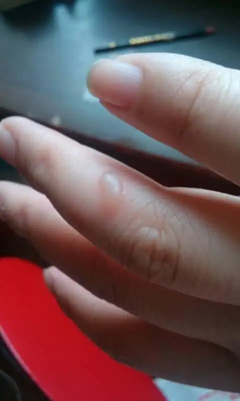 问:手上被油烫伤,起了个小泡,怎么处理?如果不弄,它自己可以好么?