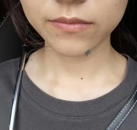 困扰求助|如图|可不可以帮我看看下巴的痣要不要切掉哇?