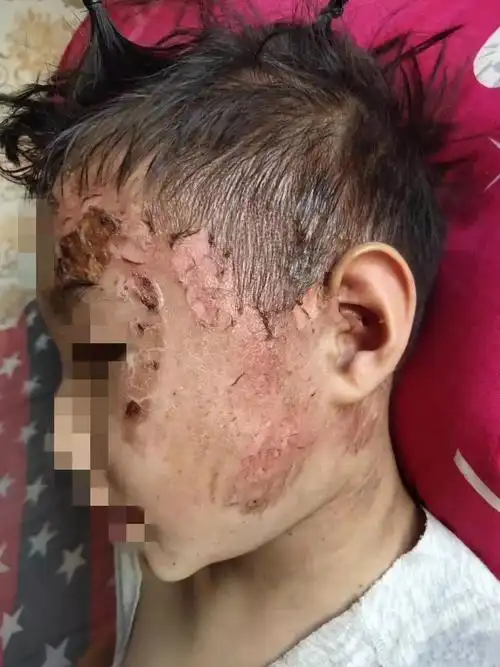 朔州一幼儿园孩子被开水严重烫伤视频曝光数百位网友留言