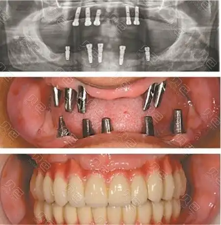 在大理做种植牙多少钱一颗?想选一家好医院有推荐名单吗