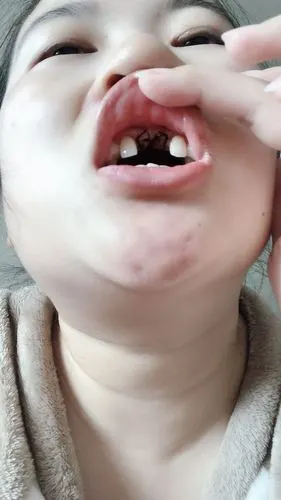 牙不好,96吃啥都没胃口,牙齿坏了好些,有的时候还痛_圈子-新氧美容