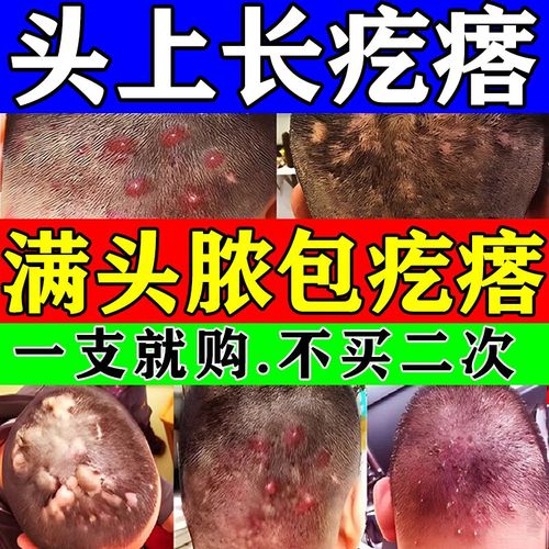 头皮毛囊炎专用药膏 克霉唑乳膏头上长疙瘩药头皮长红疙瘩痘痘脓包