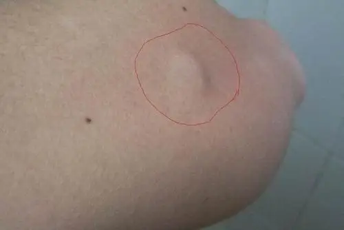 脂肪瘤到底该如何治疗?