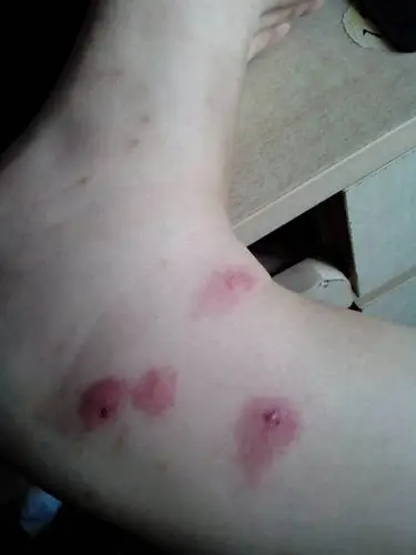 预防宝宝被虫咬皮炎图片