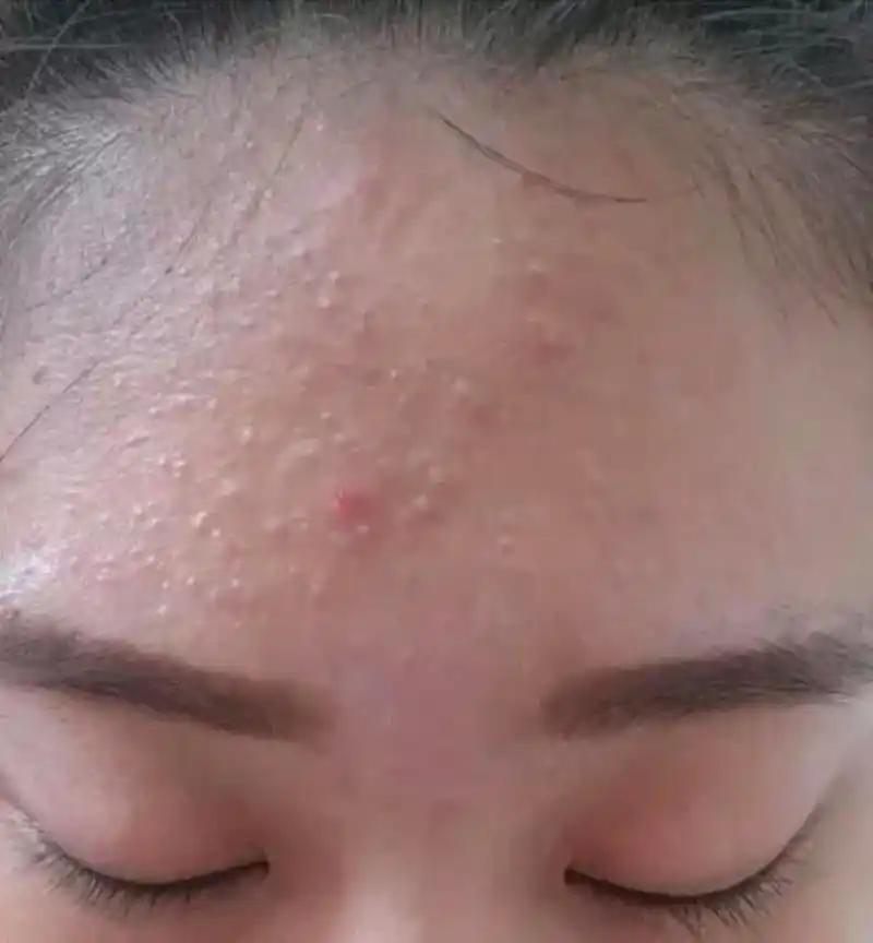 毛囊炎怎么治才能除根脸上的痘痘?