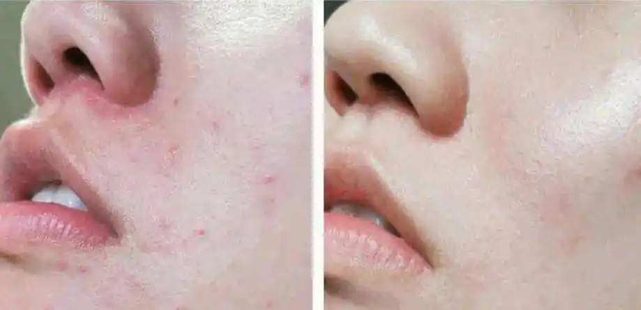 皮肤泛红怎么办这5种极常见的皮肤泛红问题解决办法在这