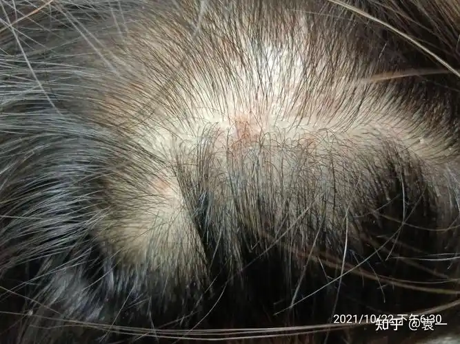头部毛囊炎到底咋治,各位大佬! - 知乎
