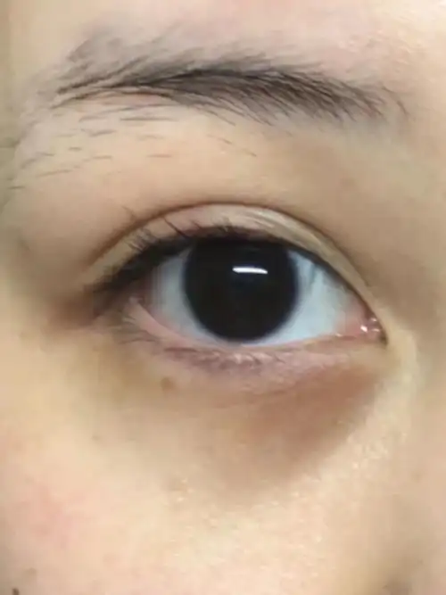 相信黑眼圈是很多女生的困扰,黑眼圈不仅会显得整个人没有精神,还会