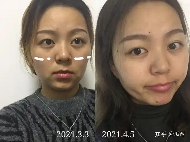 快22岁了,熬夜3年半,请问脸上胶原蛋白还能恢复吗?