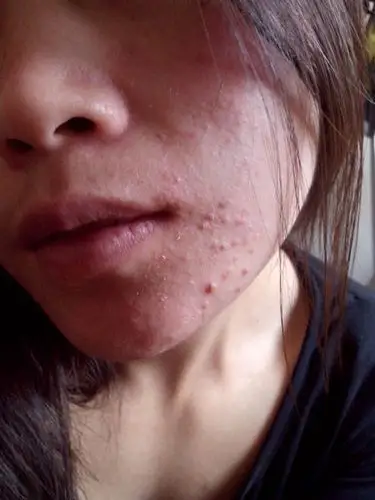 阴茎长毛囊炎的症状图片