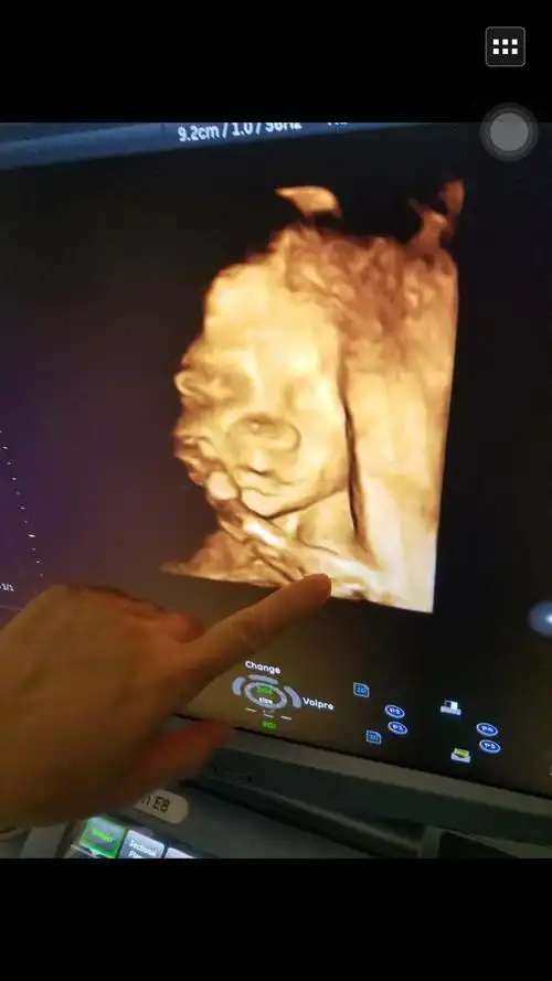 24周做的四维彩超,怎么宝宝拍出来的照片,这个样子啊,鼻子大,还有眼睛