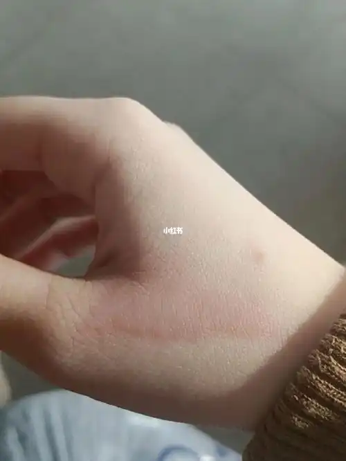 接热水手烫伤了01