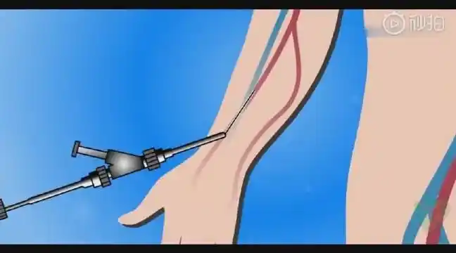 3d演示一分钟看懂心脏支架手术