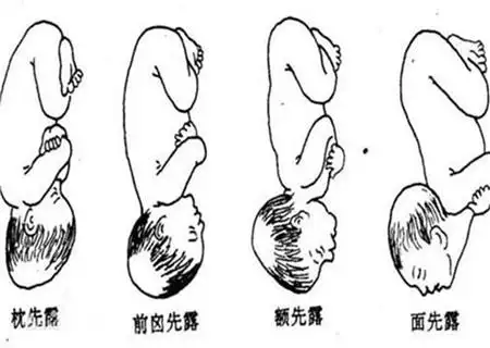 胎儿头位是什么意思头先露位又是什么呢