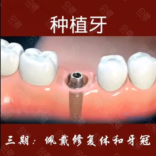 种植牙三期示意图