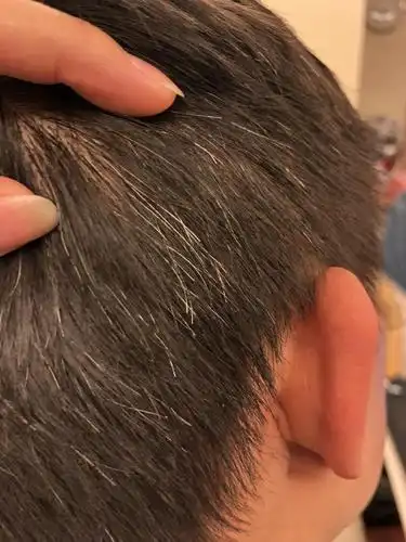 后脑勺一圈白发!请大师来诊断