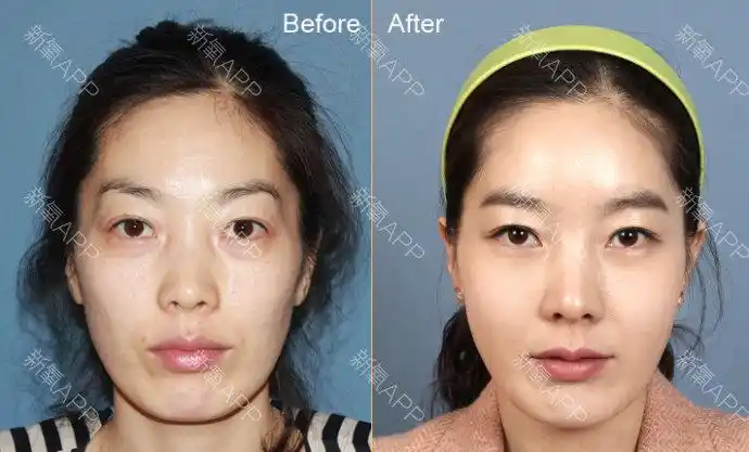 面部填充前后对比照