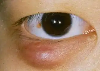 睑板腺囊肿治疗体会 - 好大夫在线