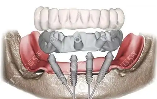 我才40岁牙齿都快掉光了看我种植牙省钱妙招