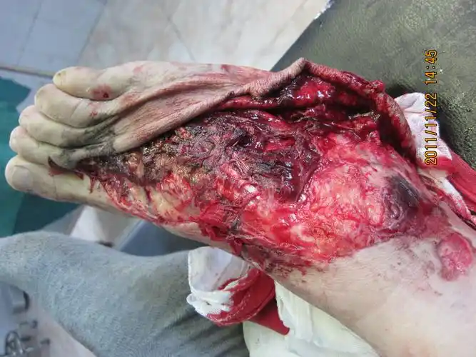 各位瞧瞧,这个病人该怎么处理(铲车轮子碾压伤)