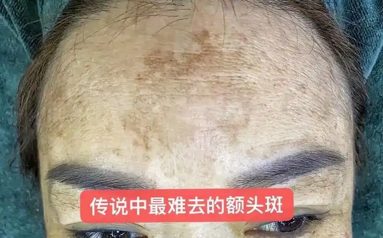 真的真祛斑,是彻底把黑色素提出并分解!