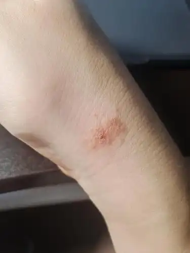 有图慎入被蚊子叮了之后包好了但是周围变成这样求解答