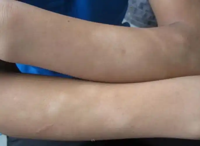 白斑病图片早期,白斑病早期症状图片-图片大观-奇异网