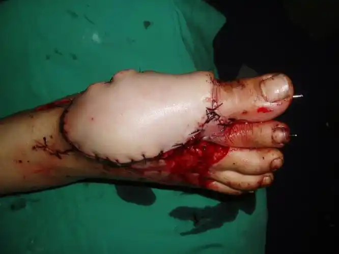 徐兴臣显微手术系列之一足趾离断异位寄生回植