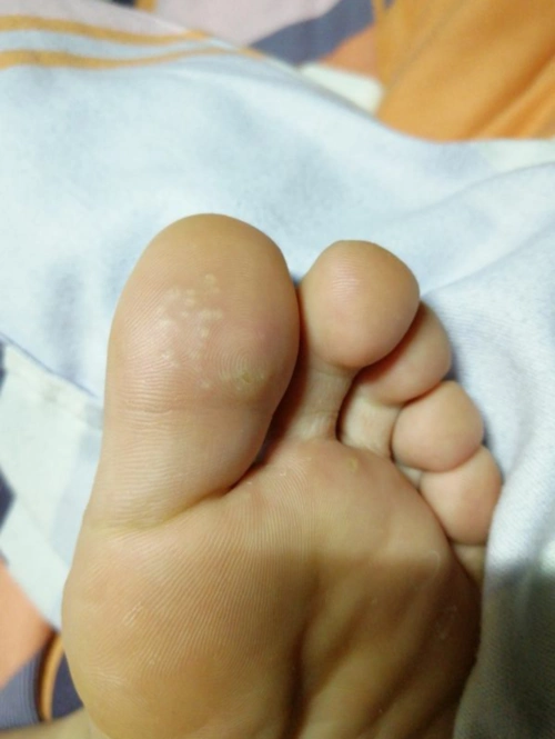 脚趾背面起了有些透明,有些黄的疙瘩,也不痛,但是摸起来不光滑,感觉比