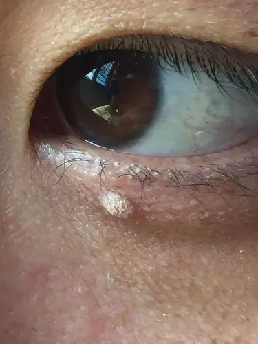 眼睛上长了一个疙瘩,感觉是很多小肉粒组成的,不知