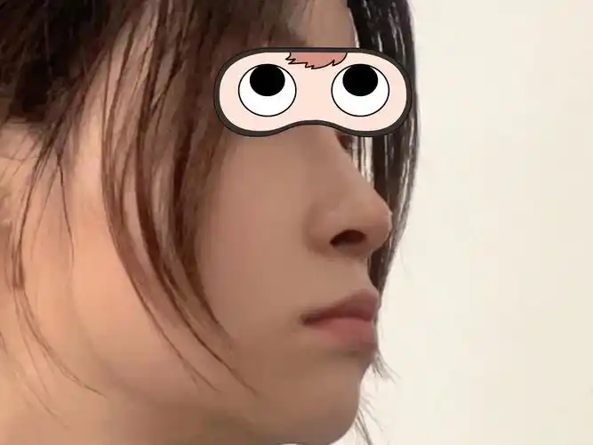 求美者术前鼻翼肥大,鼻头圆钝,矮鼻,塌鼻,鼻背高度_圈子-新氧美容整形