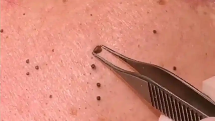 超清挤后背的黑头 极具视觉冲击力(小伙伴们关注我哦)