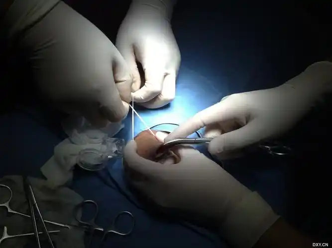 【进展】包皮套扎全过程高清图片