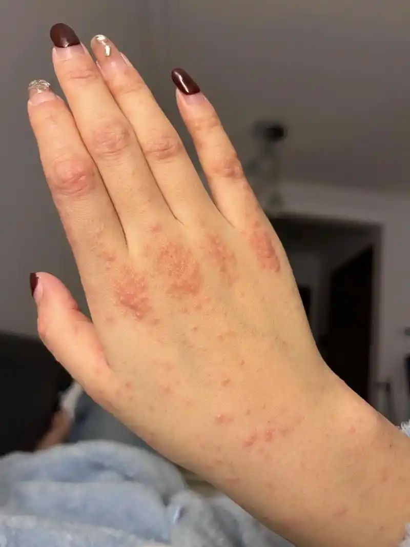 有没有同款新冠后遗症,痒得睡不着.#全身起疹子 阳康后全身起 - 抖音