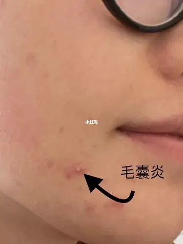 毛囊炎如何治疗
