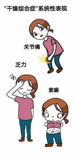 干燥综合症(得了干燥综合征怎么治疗)