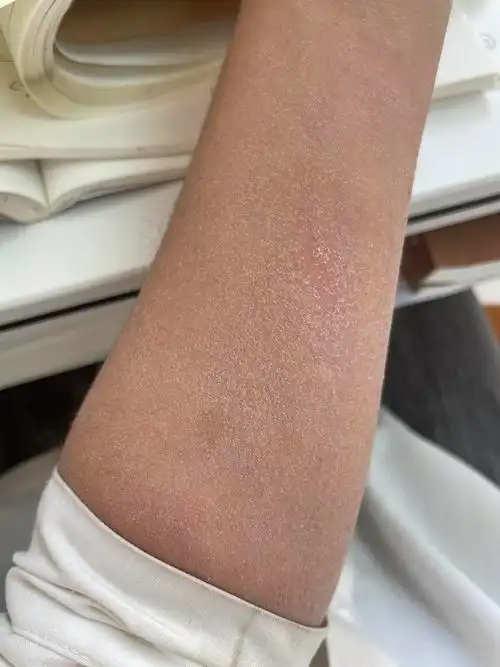 冬天皮肤干燥起皮,北方室友说是该搓澡了