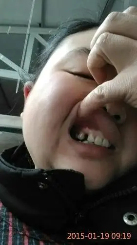 上面一个虎牙然后给下面的小牙拔掉了带个矫正器给虎牙压了下来现在又