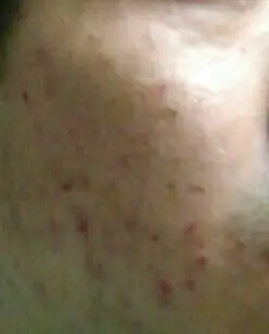 医生说有血热血毒现象该怎么治,症状是脸上和上半身前面起痤疮一样的