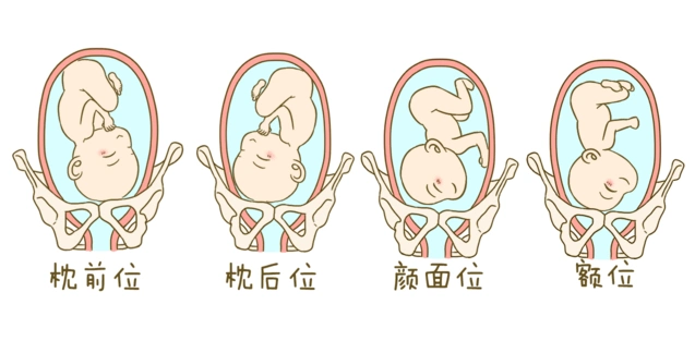 胎位roa是什么意思优质